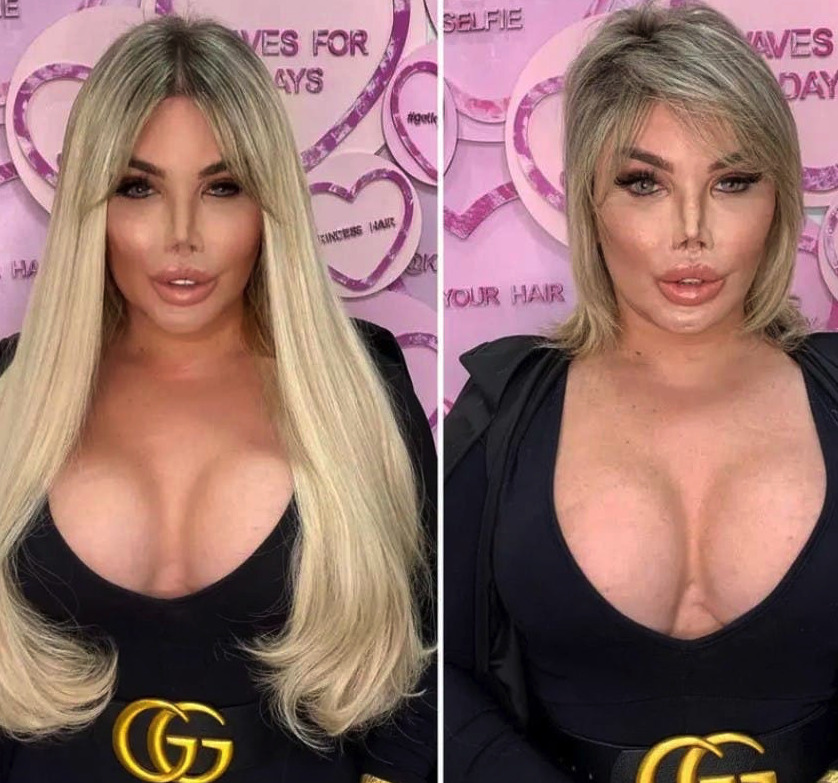 21 Botched Plastic Surgeries That Went Terribly Wrong 